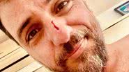 Rodrigo Lombardi surge com rosto e peitoral machucados e assusta fãs - Foto: Reprodução/Instagram