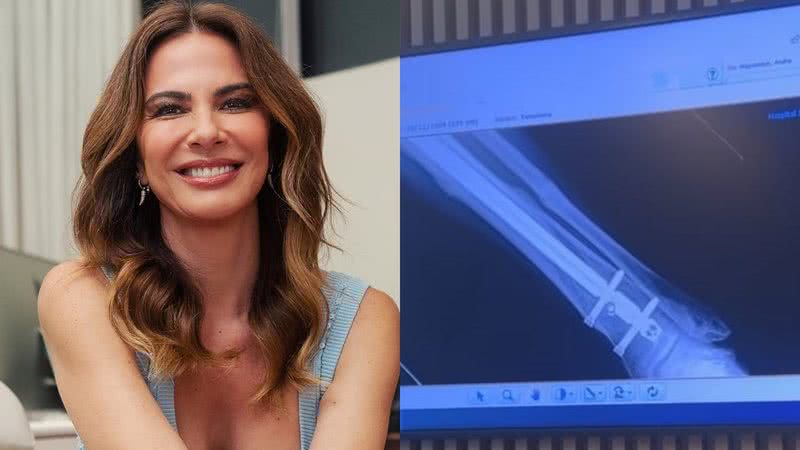 Luciana Gimenez fará nova cirurgia após acidente de esqui - Reprodução/Instagram
