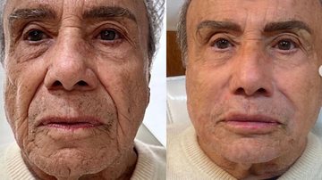 Stenio Garcia exibe antes e depois da harmonização facial - Foto: Reprodução / Instagram