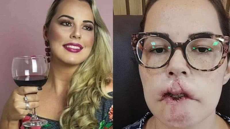 Influenciadora perde lábios após procedimento - Reprodução/Instagram