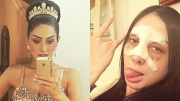 Ex-BBB Francine Piaia mostra o rosto após fraturar nariz em acidente de carro - Reprodução / Instagram
