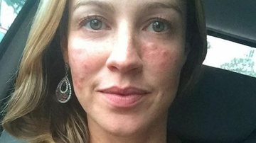 Luana Piovani aparece com o rosto inchado em foto - Reprodução/ Instagram