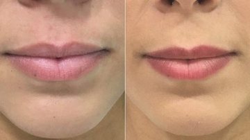 Micropigmentação dos lábios: antes e depois - Divulgação