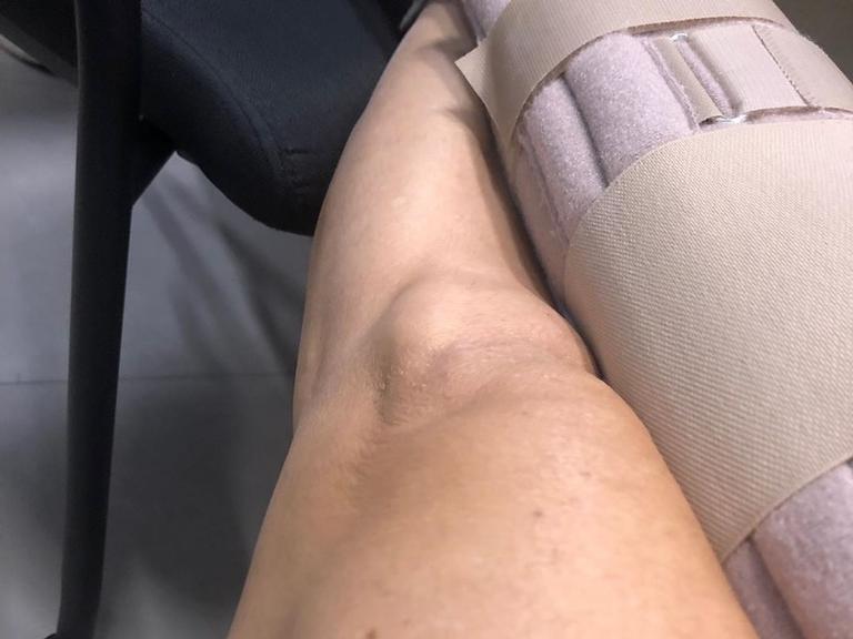 Giuliana Morrone compartilha clique de seu joelho imobilizado 