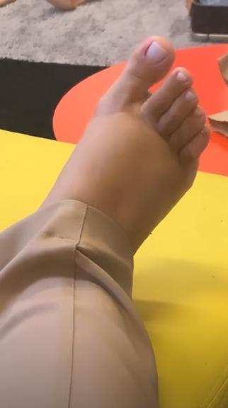 Simone exibe pés inchados após cirurgia