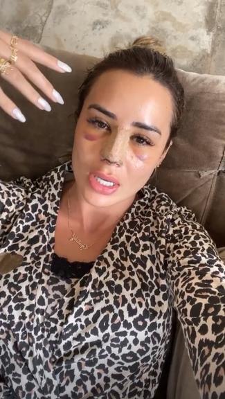 Ex-BBB Letícia Santiago aparece com o rosto roxo após cirurgia plástica