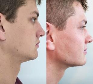 Lucas Gallina mostra antes e depois de procedimento estético