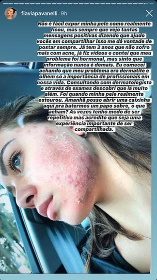 Flavia Pavanelli mostra rosto antes de tratamento para acne