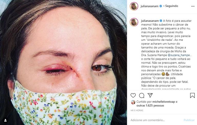 Juliana Sana mostra cicatriz no rosto e revela doença