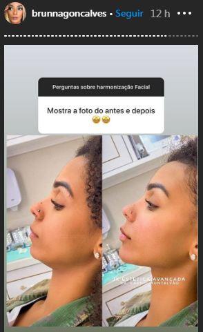 Brunna Gonçalves mostra resultado de harmonização facial