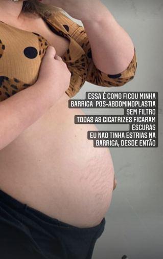 Marília Mendonça fala sobre abdominoplastia