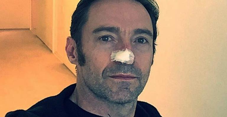 Hugh Jackman retira novo tumor do nariz