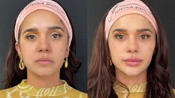 Gizelly Bicalho faz harmonização facial - Reprodução/Instagram