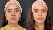 Gizelly Bicalho faz harmonização facial - Reprodução/Instagram