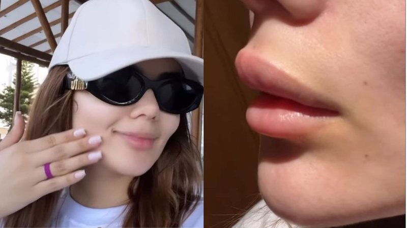 Eslovênia Marques surge com os lábios inchados após crise alérgica - Divulgação/Instagram