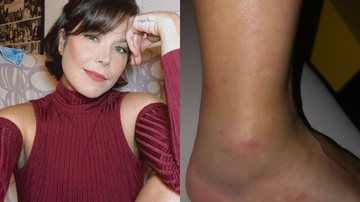 Samara Felippo dá detalhes sobre o pé machucado - Reprodução/Instagram