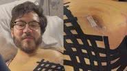 Eliezer mostra como ficou o peitoral após cirurgia - Reprodução/Instagram