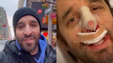 Comediante Rafinha Bastos realiza procedimento cirúrgico no nariz para conseguir respirar melhor - Foto: Reprodução / Instagram / YouTube