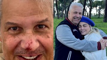 Sikêra Jr surge com o rosto machucado após alta - Reprodução/Instagram
