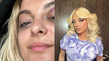 Cantora Bebe Rexha aparece com olho roxo após ser atingida no rosto com celular enquanto se apresentava - Foto: Reprodução / Instagram