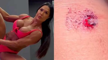 Gracyanne Barbosa sofre acidente e mostra machucado - Reprodução/Instagram