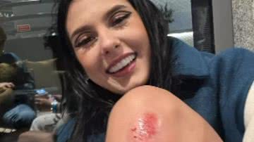 Ana Castela sofre acidente de patinete - Foto: reprodução/Instagram