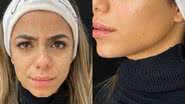 Ex-BBB Key Alves realiza harmonização facial - Reprodução/Instagram
