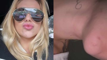 Virginia Fonseca acorda com alergia - Reprodução/Instagram