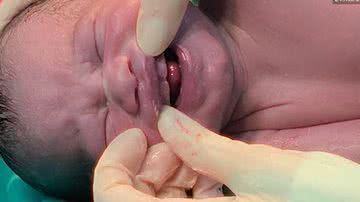 Bebê nasce com 6 dentes no Mato Grosso do Sul - Reprodução/Instagram/luciana.obstetra