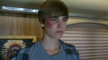 Justin Bieber aparece com o olho roxo - Reprodução