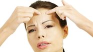 Acne na idade adulta são comuns - Shutterstock
