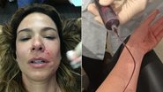 Luciana Gimenez faz tratamento estético com sangue - Instagram/Reprodução