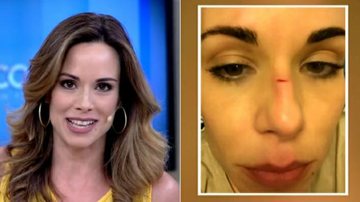 Ana Furtado revela ter sofrido acidente doméstico - TV Globo/Reprodução
