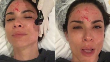 Com sangue no rosto, Luciana Gimenez reclama de dor em tratamento de beleza - Instagram/Reprodução
