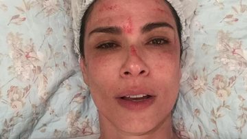 Luciana Gimenez aparece com o rosto sangrando em tratamento de beleza - Instagram/Reprodução