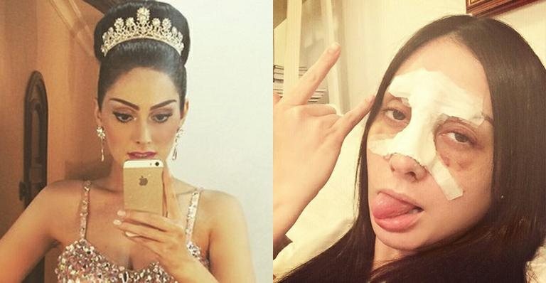 Ex-BBB Francine Piaia mostra o rosto após fraturar nariz em acidente de carro - Reprodução / Instagram