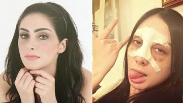 Após sofrer acidente, Francine Piaia mostra como ficou seu rosto - Instagram/Reprodução