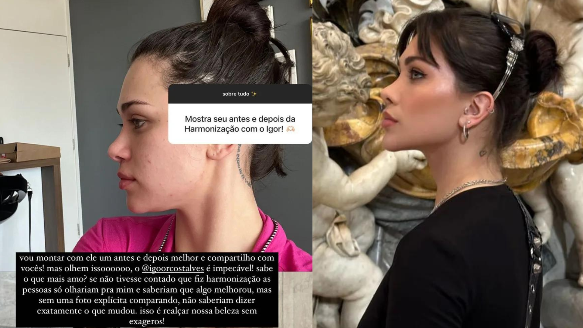 Flávia Pavanelli mostra antes e depois de harmonização facial - Instagram