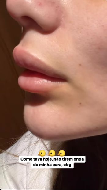 Eslovênia Marques surge com os lábios inchados após crise alérgica
