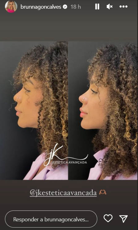 Antes e depois de harmonização facial de Brunna Gonçalves. Foto: Reprodução/Instagram