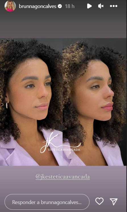 Brunna Gonçalves compartilha resultado da harmonização facial. Foto: Reprodução/Instagram