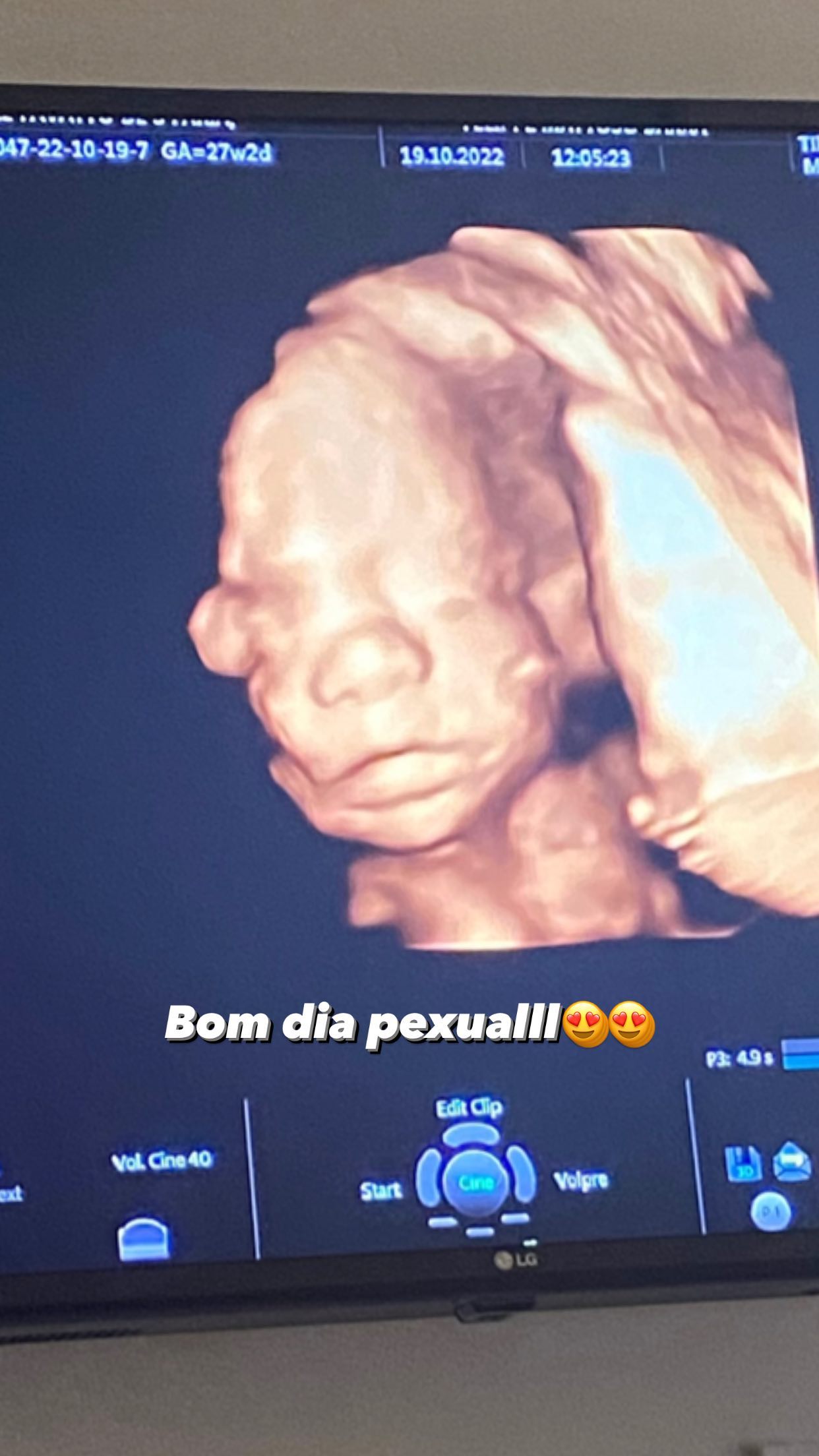 foto do ultrassom 3D do bebe de Danielle favatto