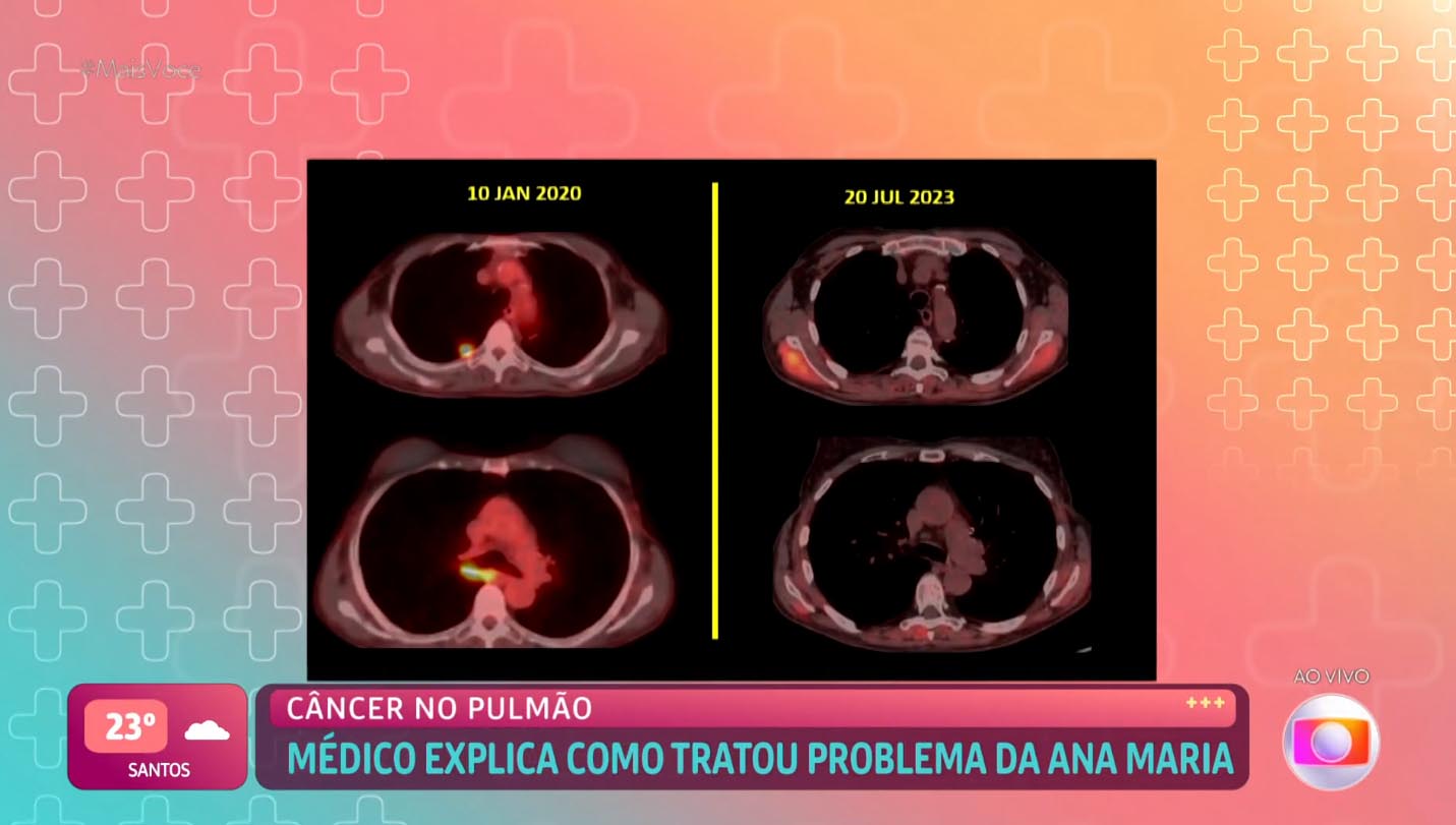 Ana Maria Braga exibe imagens dos seus exames durante a luta contra o câncer