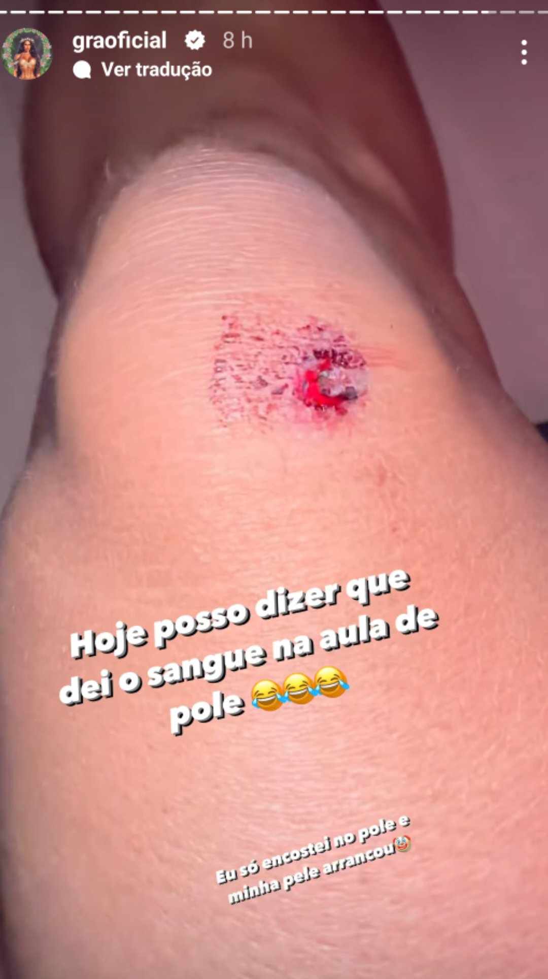 Gracyanne Barbosa machucado