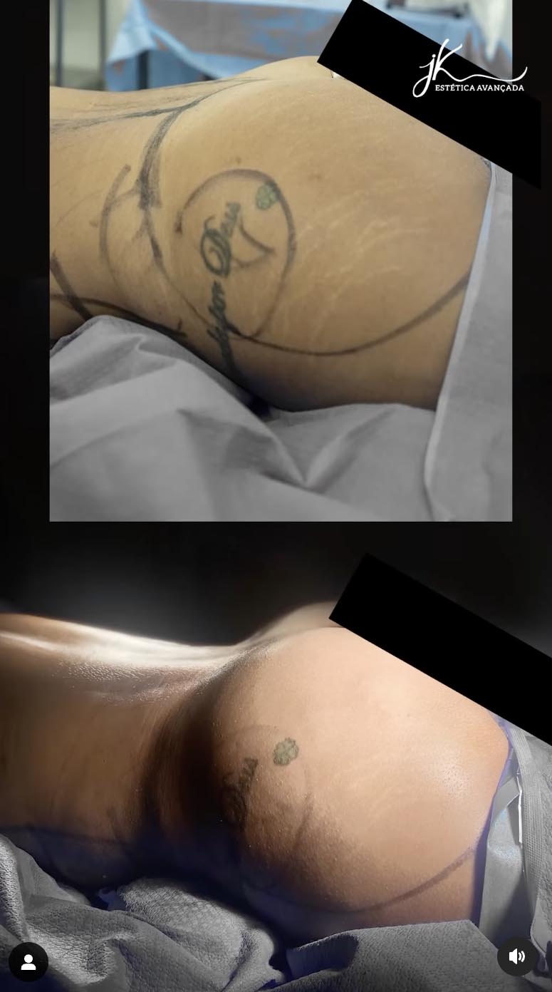 Domitila Barros mostra antes e depois da lipoaspiração