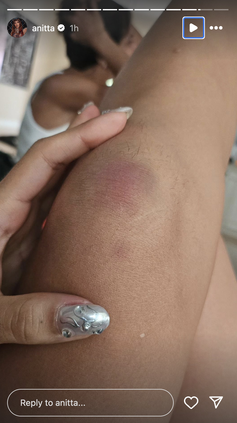 Machucado no joelho de Anitta
