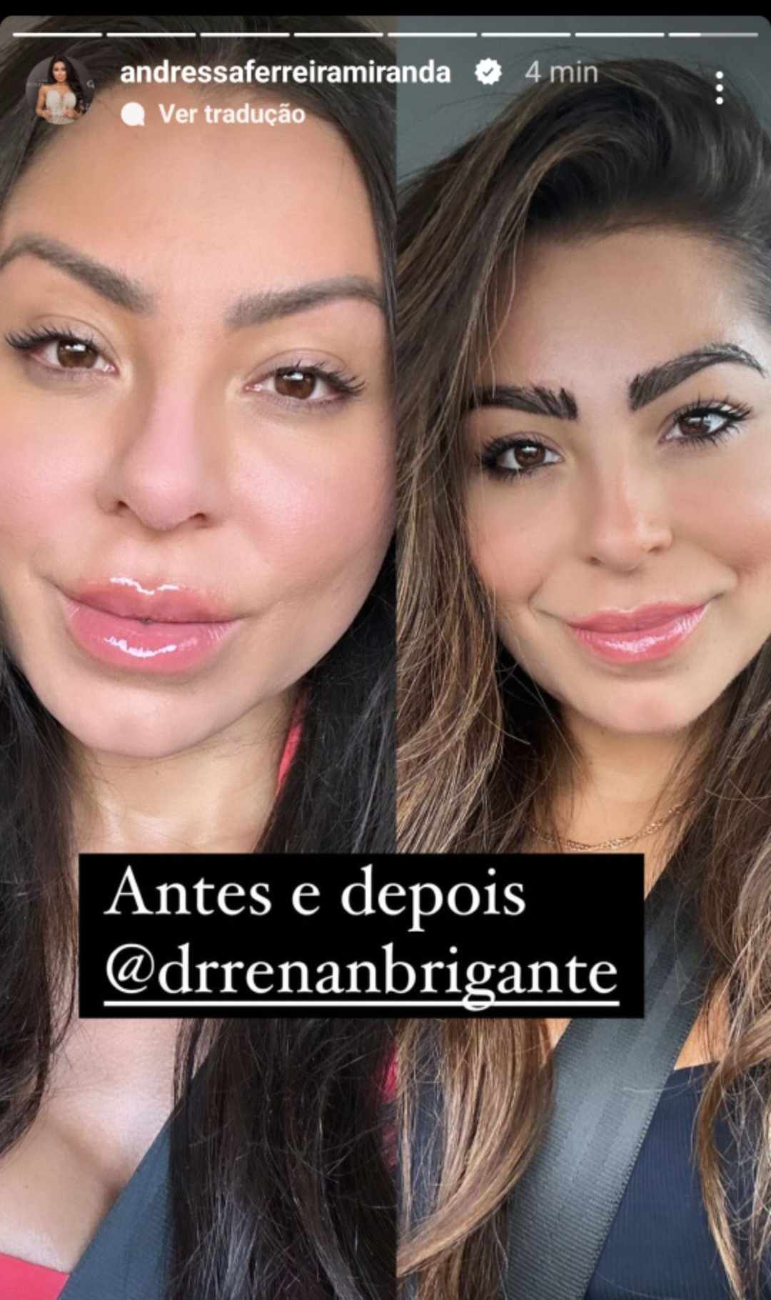 antes e depois sobrancelha Andressa Ferreira