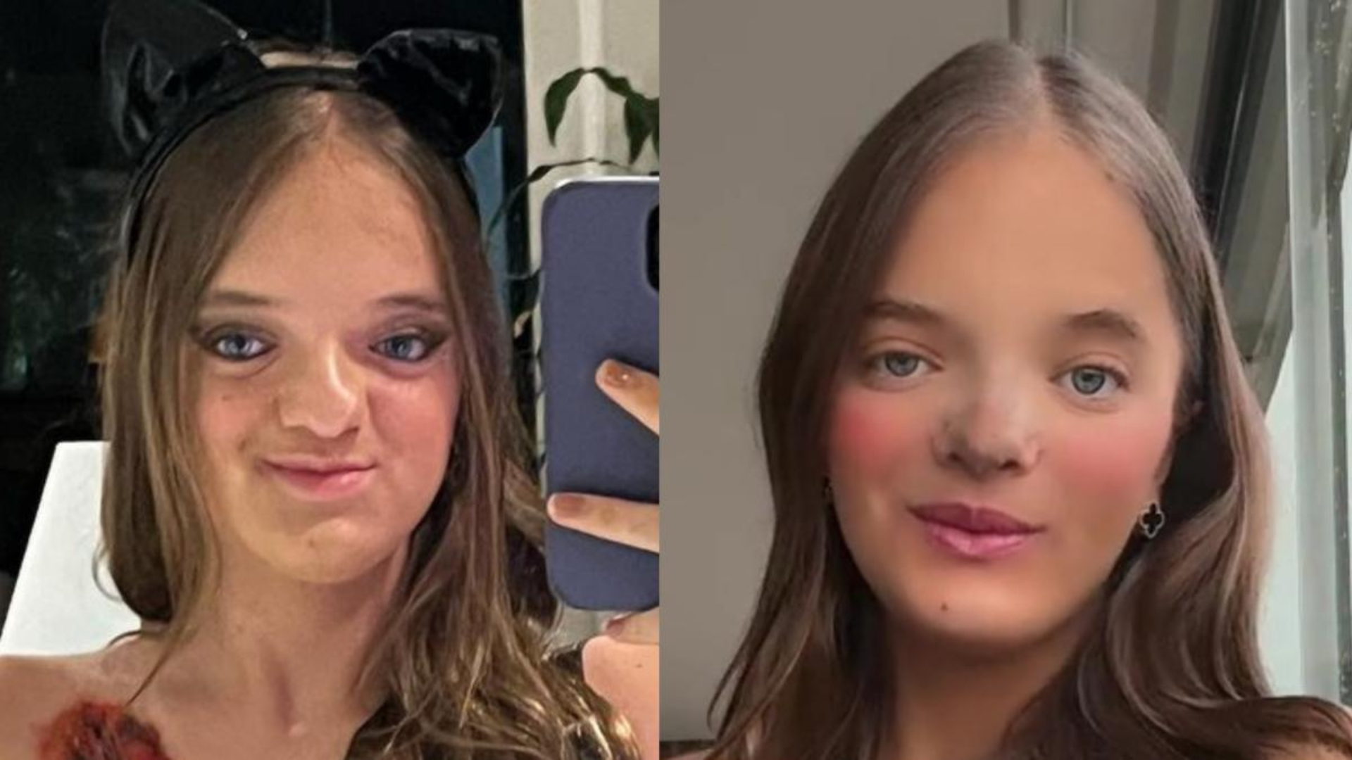 Antes e depois de rinoplastia de Rafaella Justus