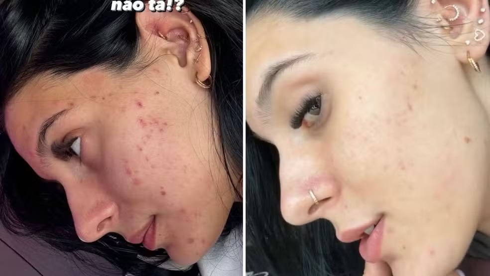 Ana Castela mostra antes e depois do rosto (Reprodução/Instagram)