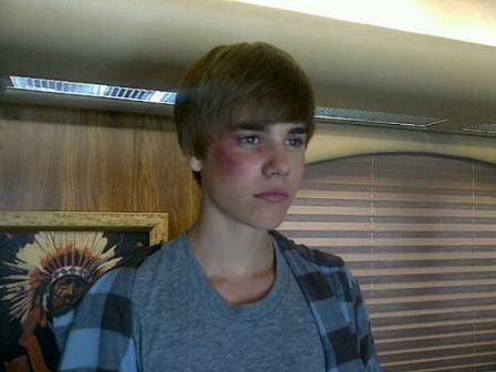 Justin Bieber aparece com o olho roxo